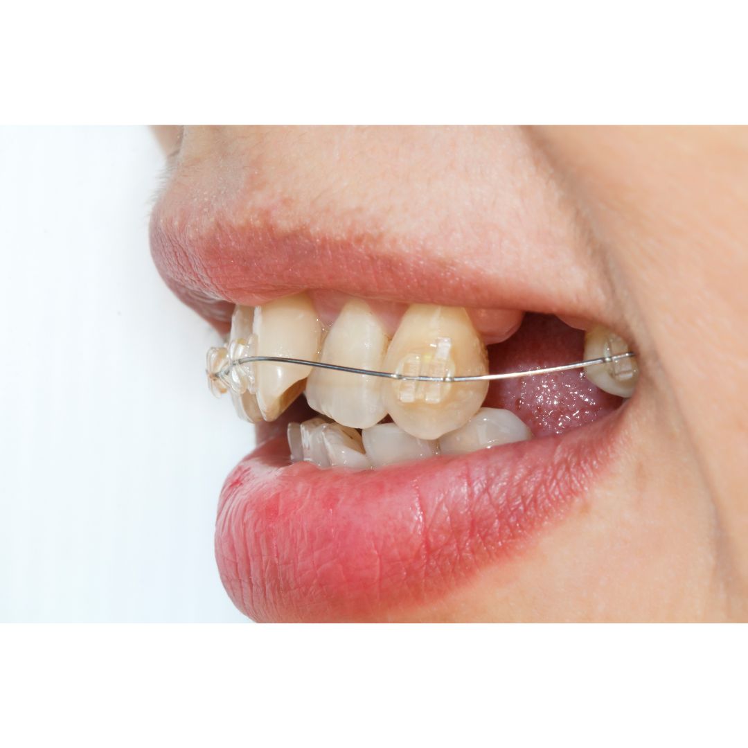 矯正で抜歯は必須？非抜歯で矯正する方法はあるの？徹底解説！｜【和光