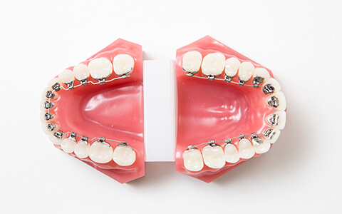リンガルブラケット矯正 | 福岡市西区の智治矯正歯科