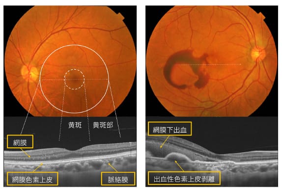加齢黄斑変性について｜社会医療法人三栄会 ツカザキ病院