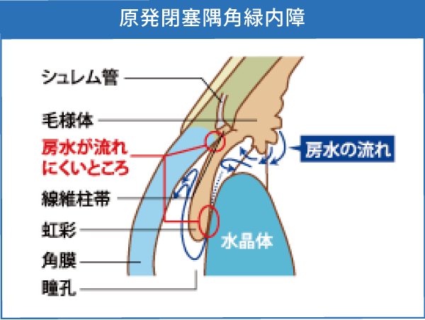 緑内障 | つかだ眼科医院 | 水戸駅北口から徒歩3分のまちの眼科