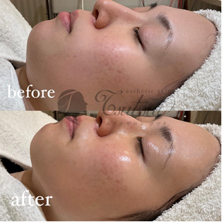 年齢肌に挑む''ふっくらハリのある肌へ”最強エイジングケア「デュアル