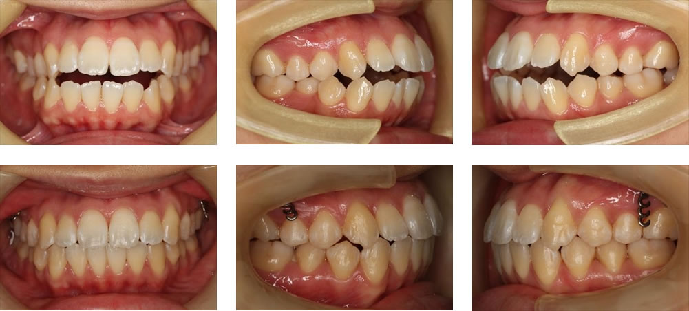 非抜歯矯正の治療例（20代女性・治療期間3年7ヶ月） | UC矯正歯科