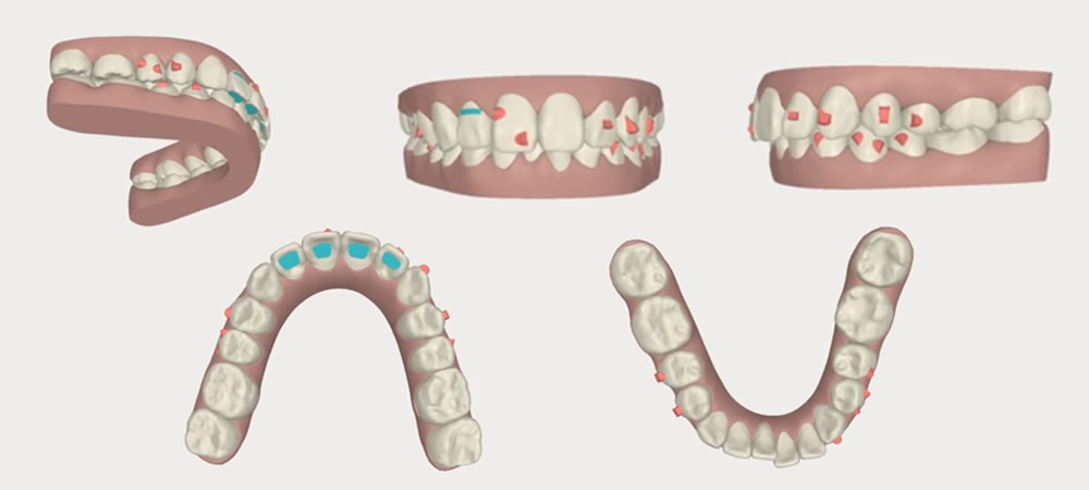 歯を抜かない矯正治療(非抜歯矯正)｜東京都港区麻布十番のUC矯正歯科