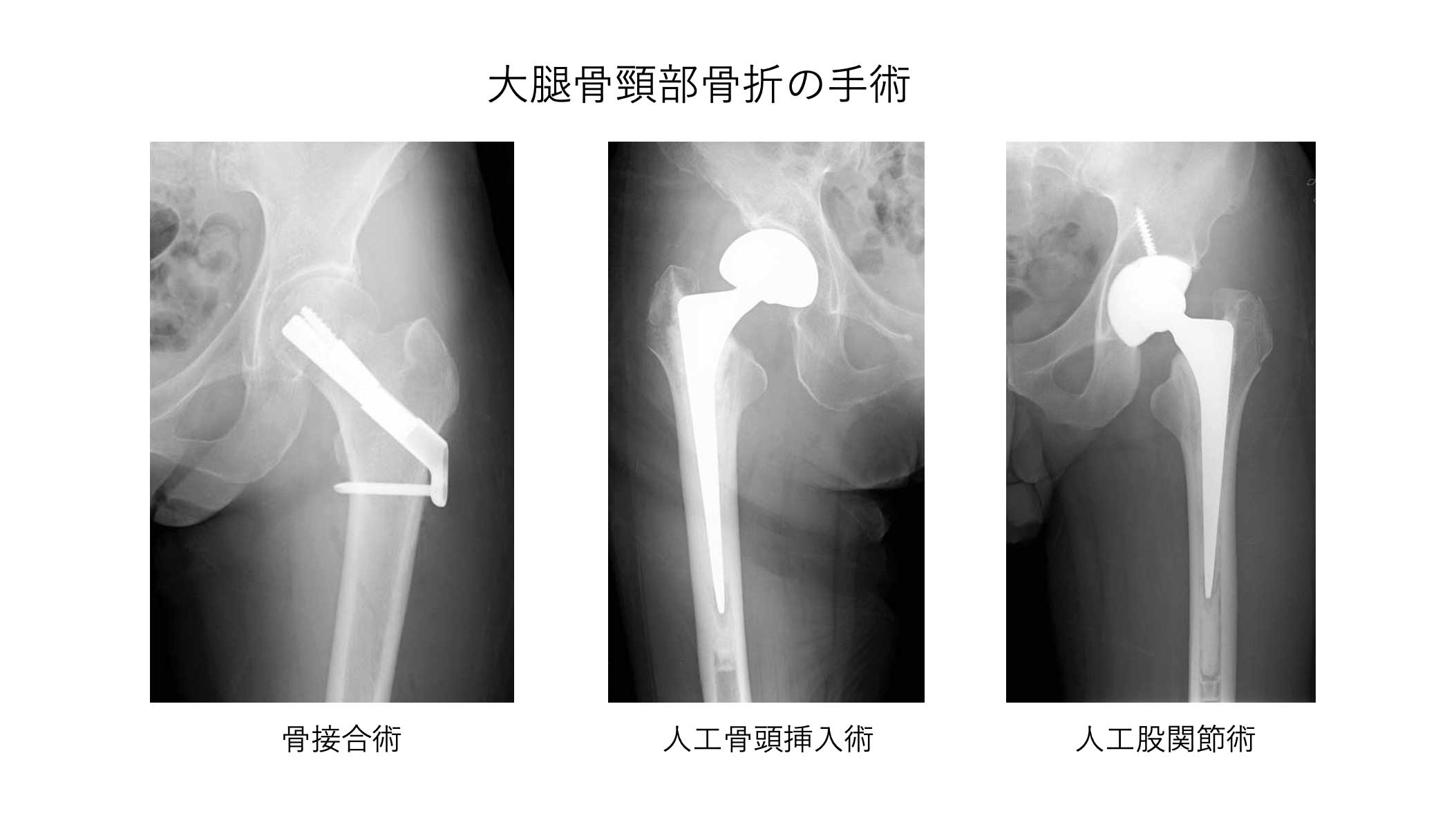 大腿骨近位部骨折について｜松山市救急指定病院 医療法人ミネルワ会