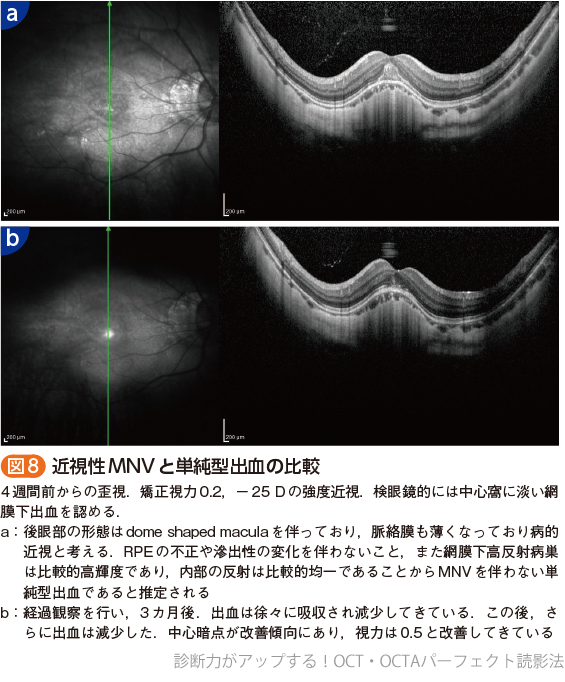 診断力がアップする！OCT・OCTAパーフェクト読影法〜正常・異常所見の