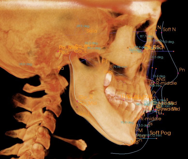 矯正治療前に知っておくべき！セファロ分析の重要性～セファロを撮ら