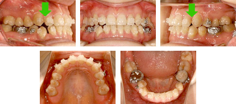失敗矯正例5】途中なのに治療終了の宣告 - Yogosawa Foundation