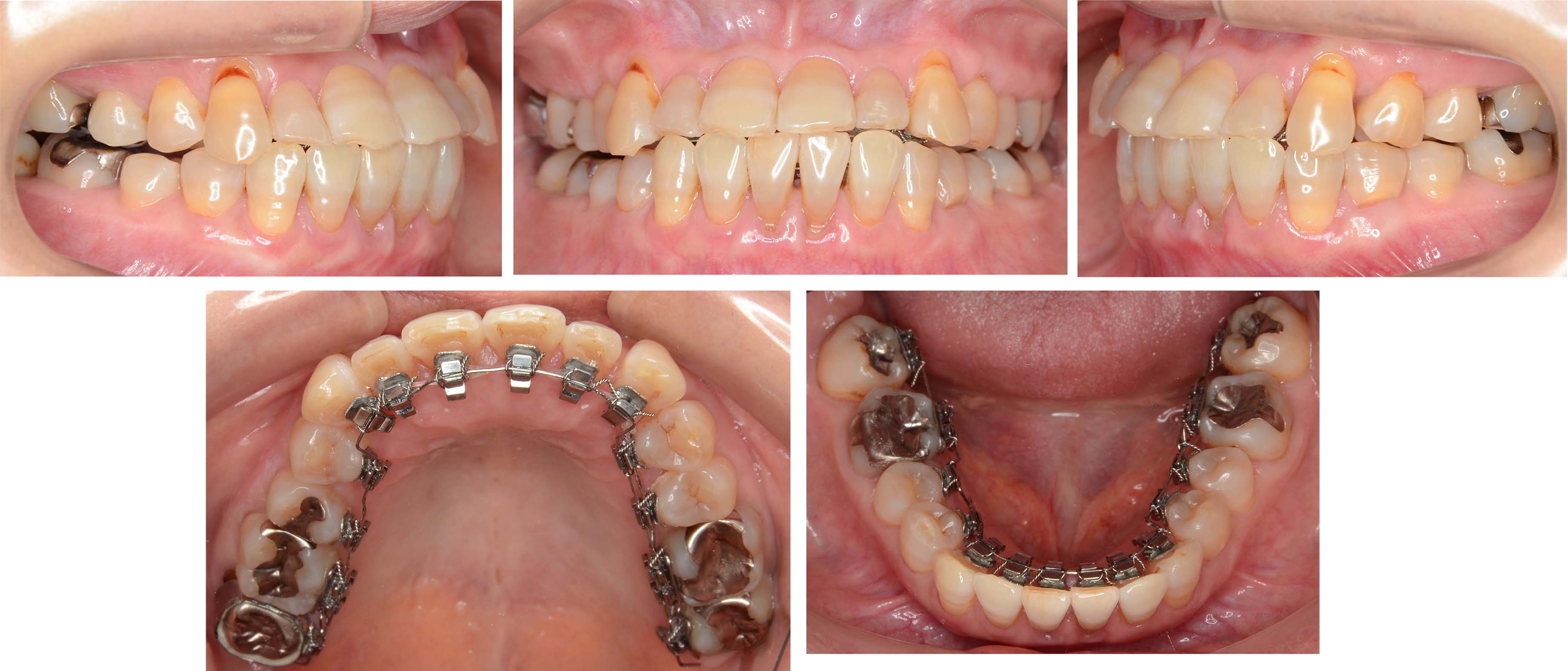 60歳から矯正治療は可能？そのリスクは？何歳まで歯科矯正が可能か