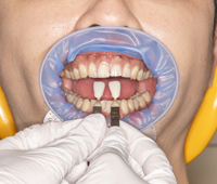 FEEDデンタル】オプトラゲートの通販｜開口器、ティッシュリトラクター