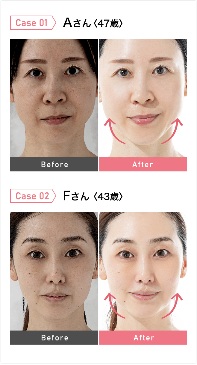 スキンケア革命】スキンアイロン - 韓国発！20万台完売の1台6役の