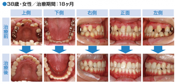No.97 上下顎前突の治療 | ふかつ歯科・矯正歯科 広島県福山市の矯正