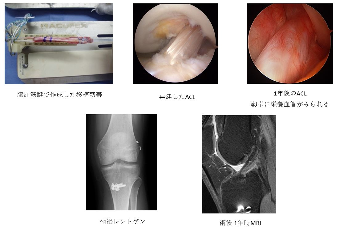 膝スポーツ人工関節センター | 群馬中央病院 | 地域医療機能推進機構
