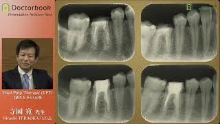 Vital Pulp Therapy(VPT) 現状とその未来 - YouTube