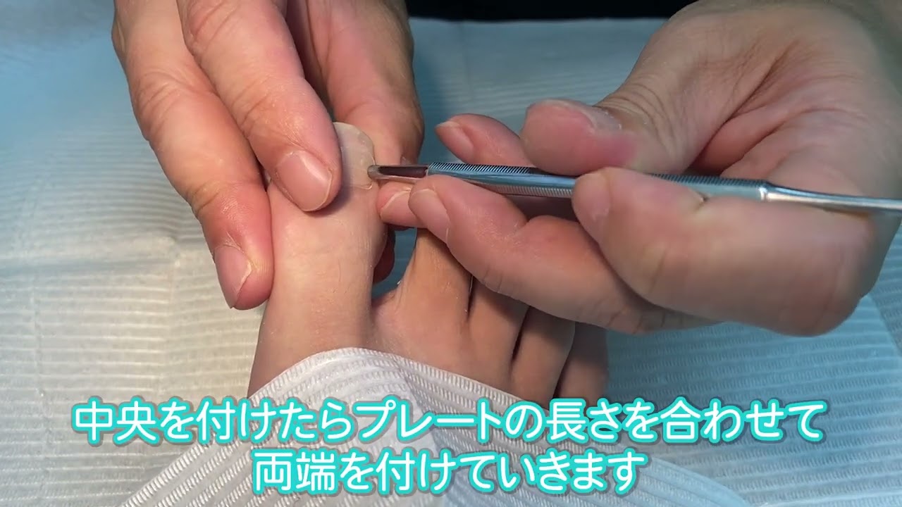 巻き爪 】～爪の表面に貼るだけ～BSスパンゲのプレートを使った巻き爪