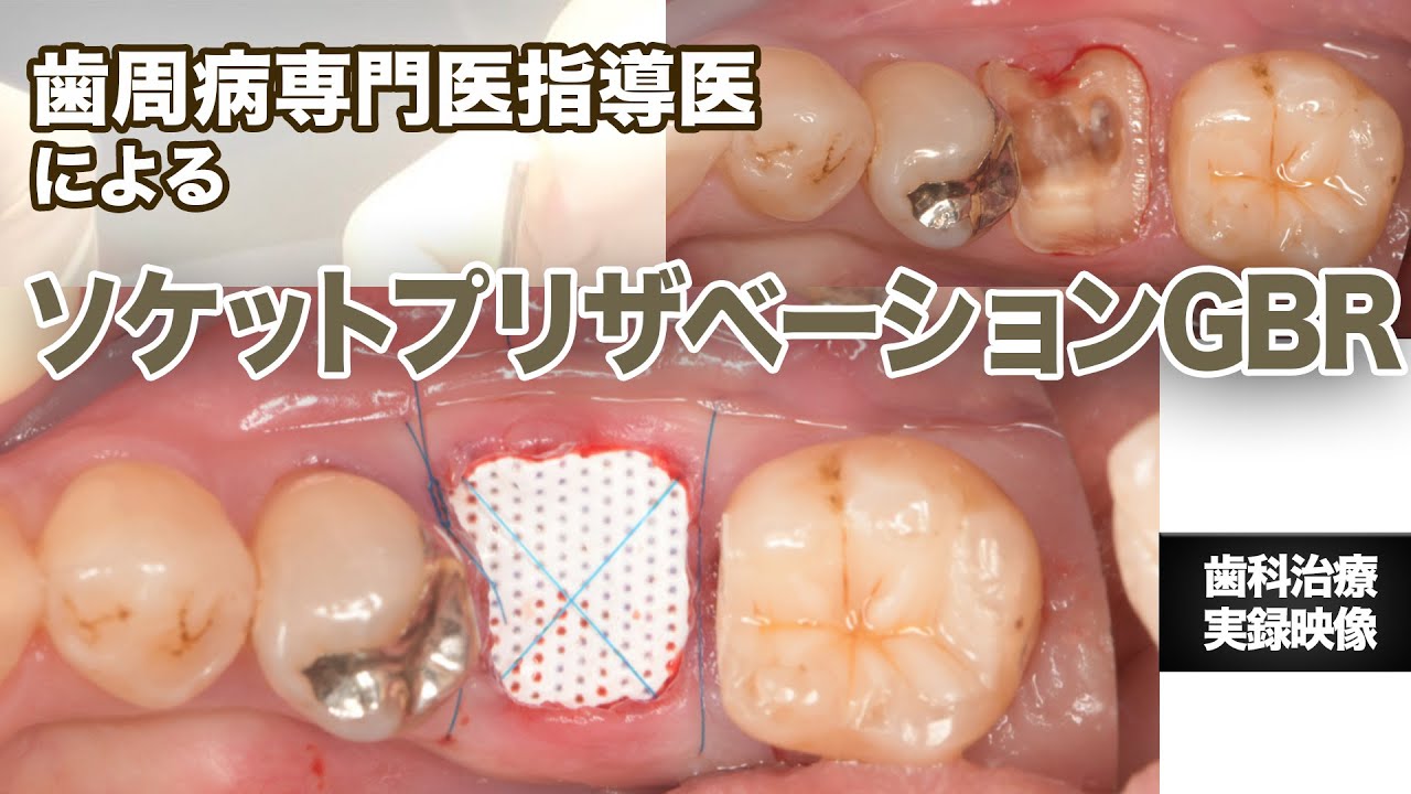 ソケットプリザベーションGBR【骨誘導再生法】 - YouTube