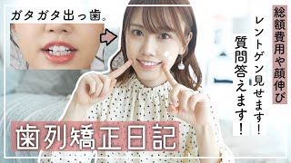 歯列矯正】インビザライン1年2ヶ月🦷費用/顔伸びた!?/レントゲン写真