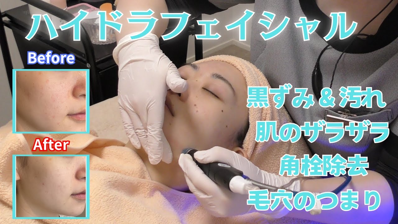 毛穴洗浄ハイドラフェイシャル｜高崎・太田の美容皮膚科