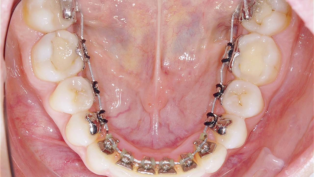 舌側矯正・裏側矯正｜熊本駅前矯正歯科クリニック