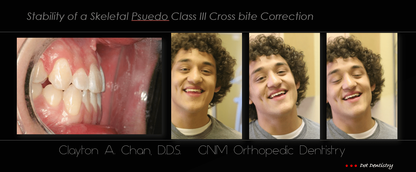 Orthodontics: Psuedo Class III Maxillary Arch Correction with GNM