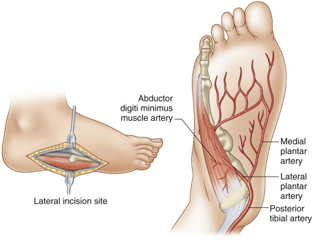 Local Flaps in the Foot | Plastic Surgery Key