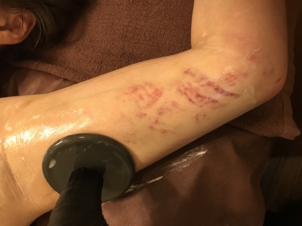 インディバ 脂肪吸引/美容整形/各種手術のアフターケア - インディバ