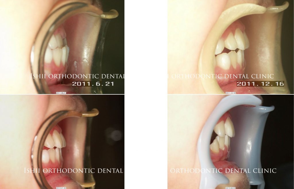 顎関節に運動制限がある反対咬合治療は難しい album 241 | 石井歯科
