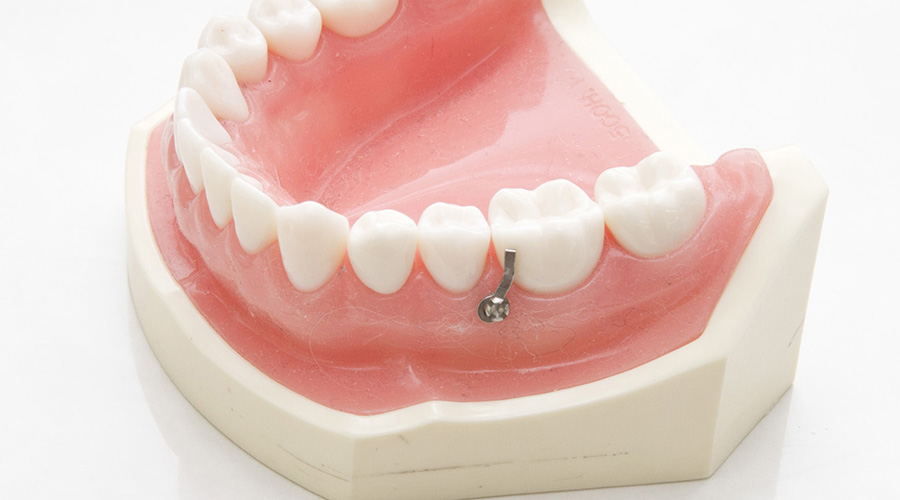 歯科矯正用アンカースクリュー – 茨城県石岡市の矯正専門歯科・歯医者