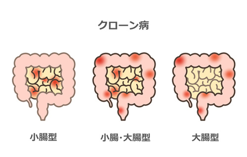 クローン病（CD） | 神宮の杜 よこやまクリニック 熱田区 | 胃腸内科