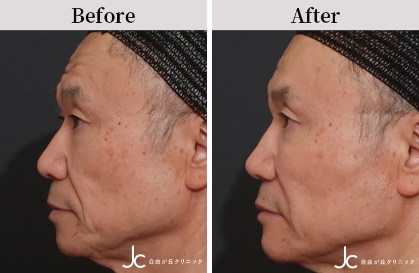 ヒアルロン酸注射なら自由が丘クリニック【注入療法専門サイト】