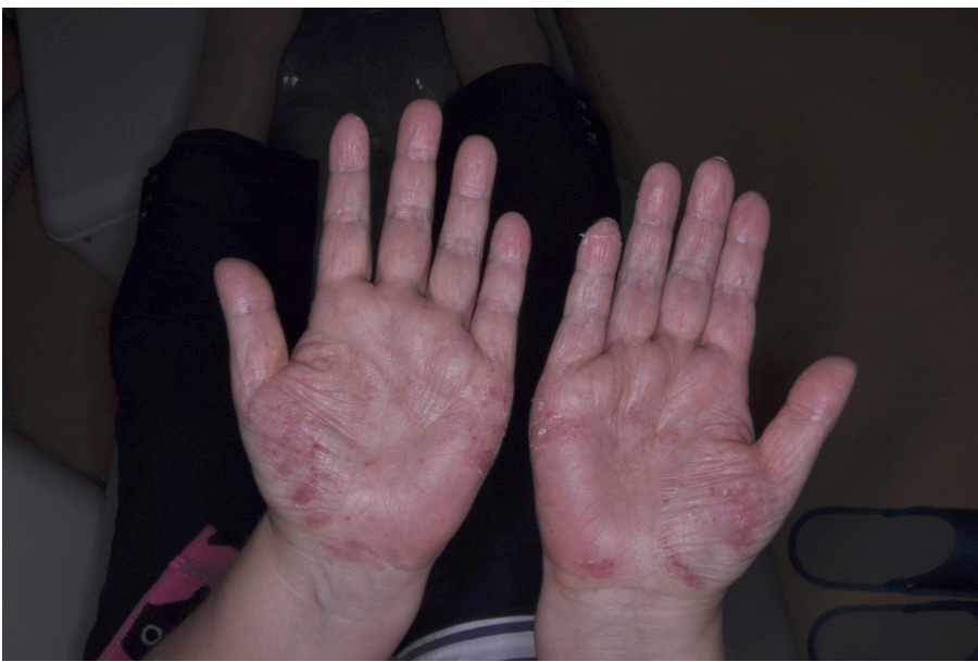 掌蹠膿疱症と歯科治療