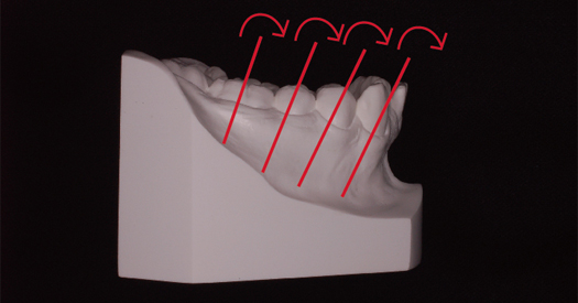 ○裁断済 非抜歯矯正治療 Molar Oriented Orthodontics 非抜歯矯正治療