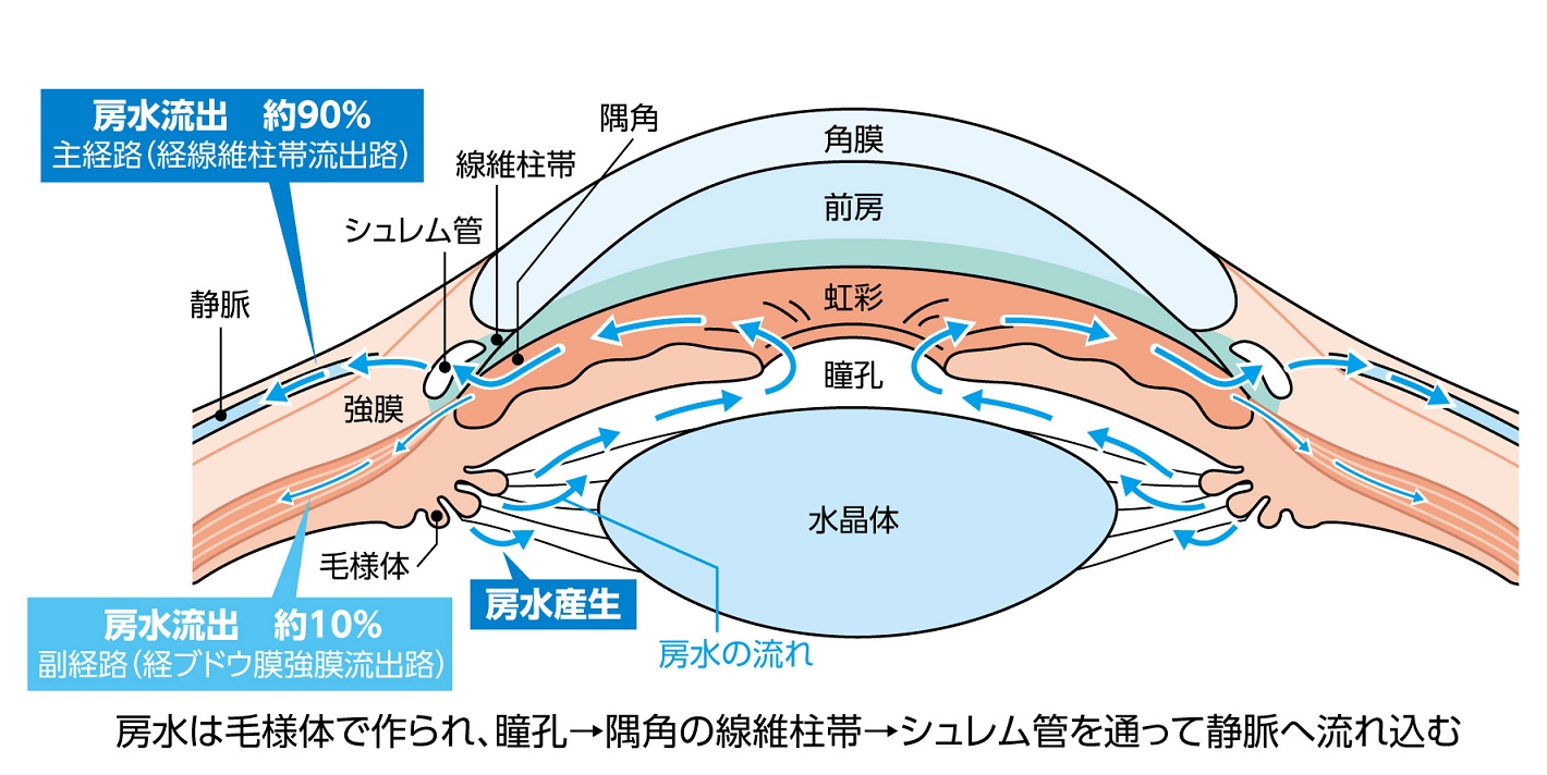 原発開放隅角緑内障 (よくある目の病気 86) ｜ 京橋クリニック眼科