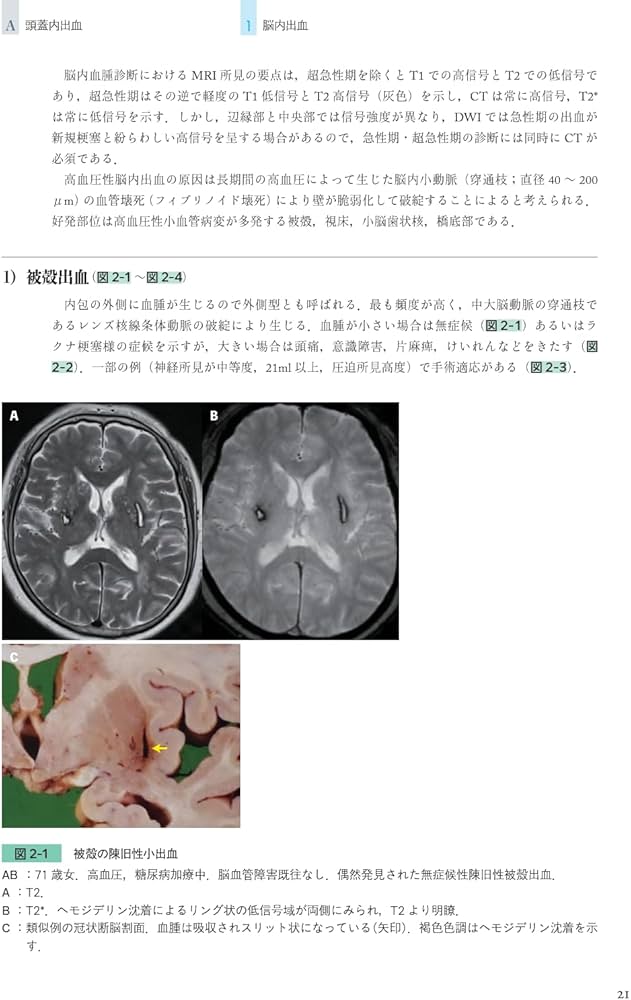 同一症例の経過・画像・病理で紐解く 臨床神経病理ワールド | 宇高不可