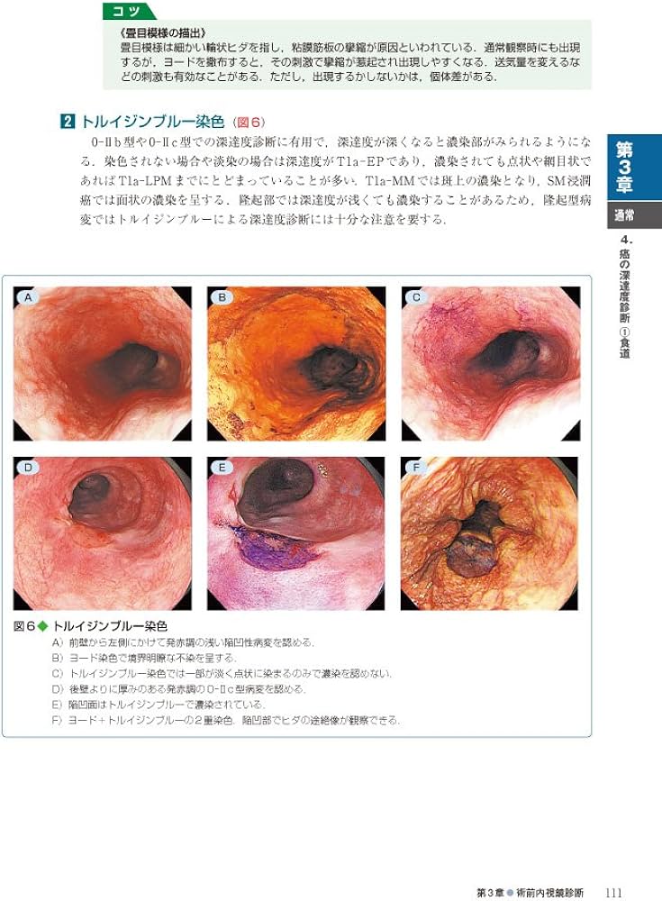 食道・胃腫瘍診断改訂版〜確実な鑑別・深達度診断のためのコツとCase