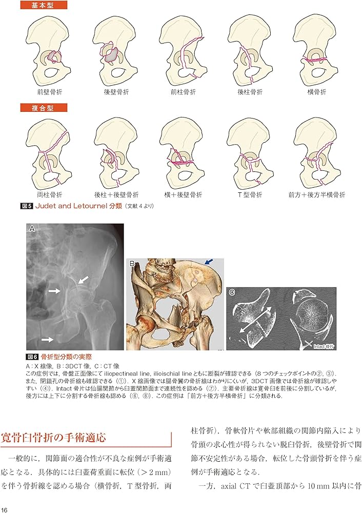 骨盤骨折: 寛骨臼骨折・骨盤輪骨折の手術手技 (整形外科SURGICAL