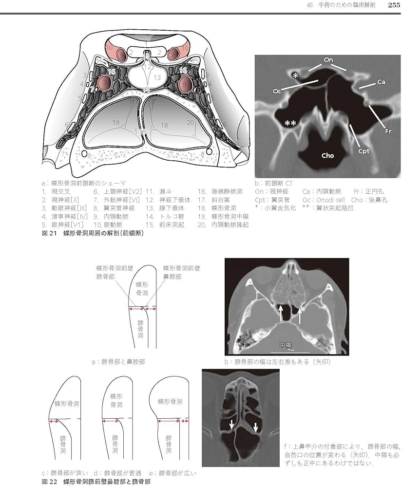 耳鼻咽喉・頭頸部手術アトラス[上巻] 第2版 | 森山 寛 |本 | 通販 | Amazon
