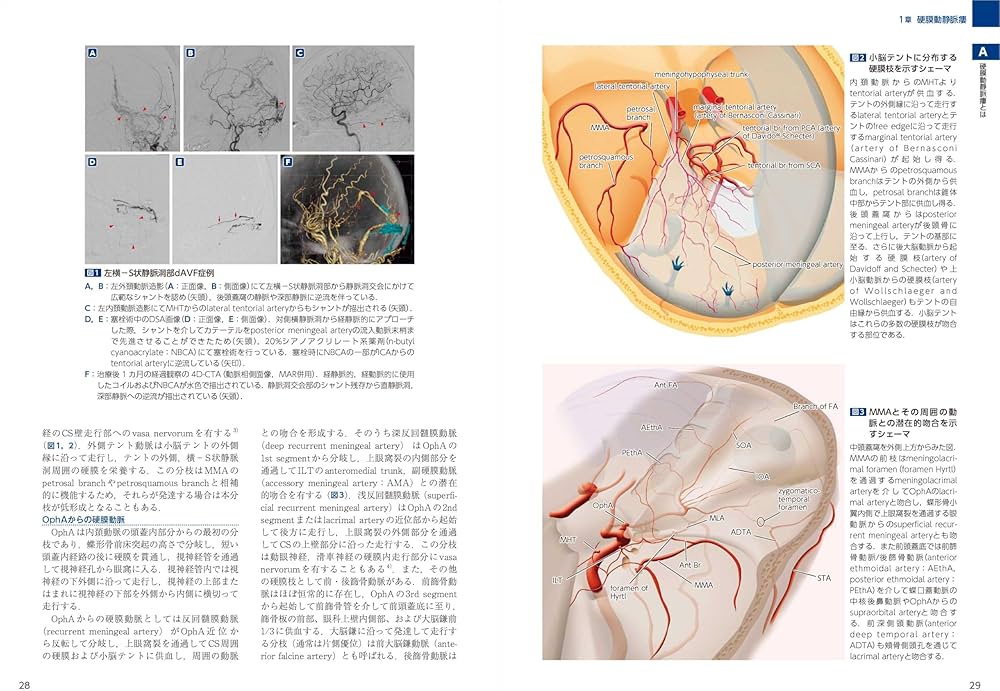 dAVF・AVM（硬膜動静脈瘻・脳動静脈奇形）のすべて：中枢神経系