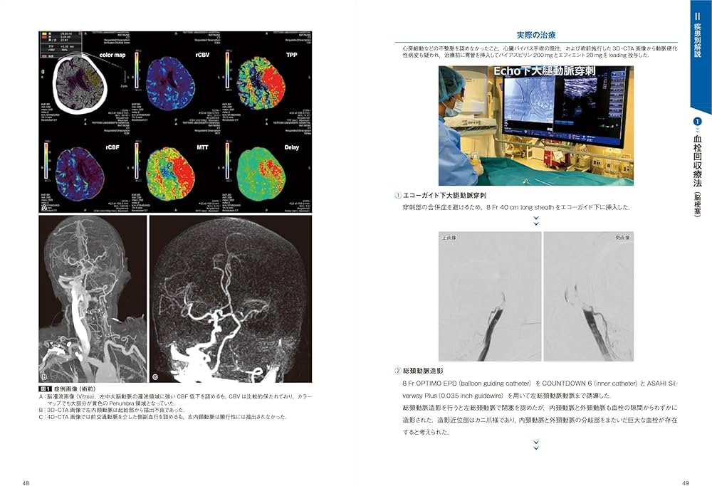 脳血管内治療の基本テクニック：コマ送り解説で知識と技術が結びつく