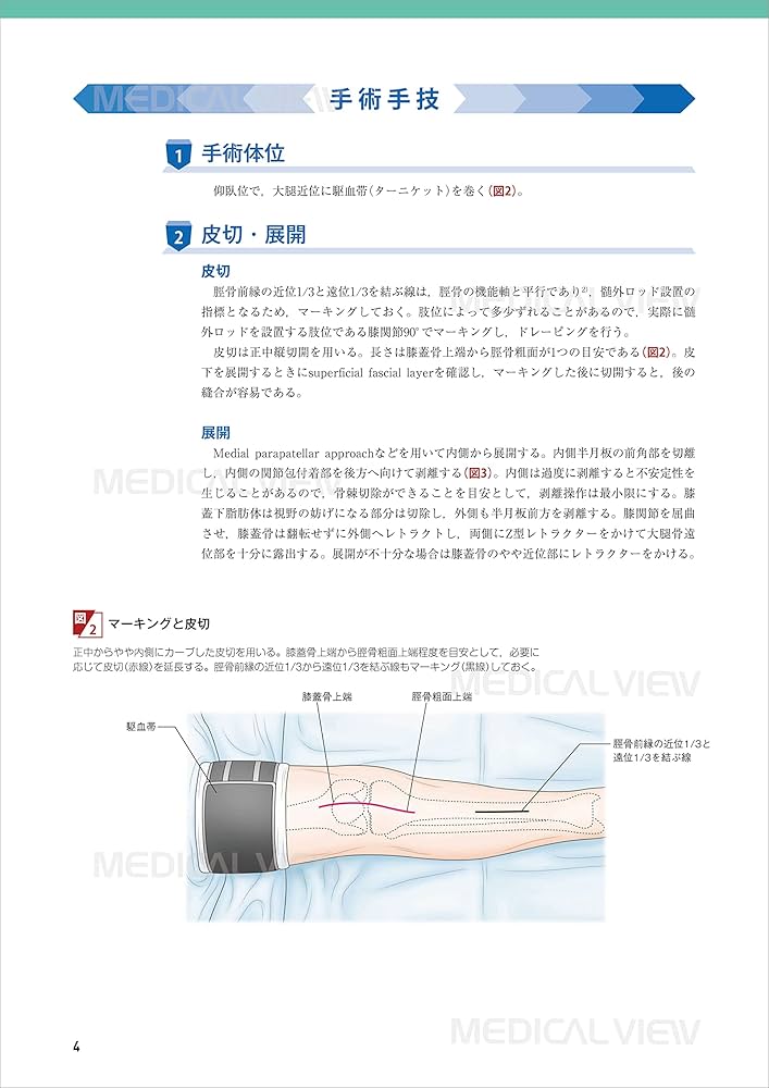 膝関節の再建手術 (新OS NEXUS No.1) | 松田 秀一 |本 | 通販 | Amazon