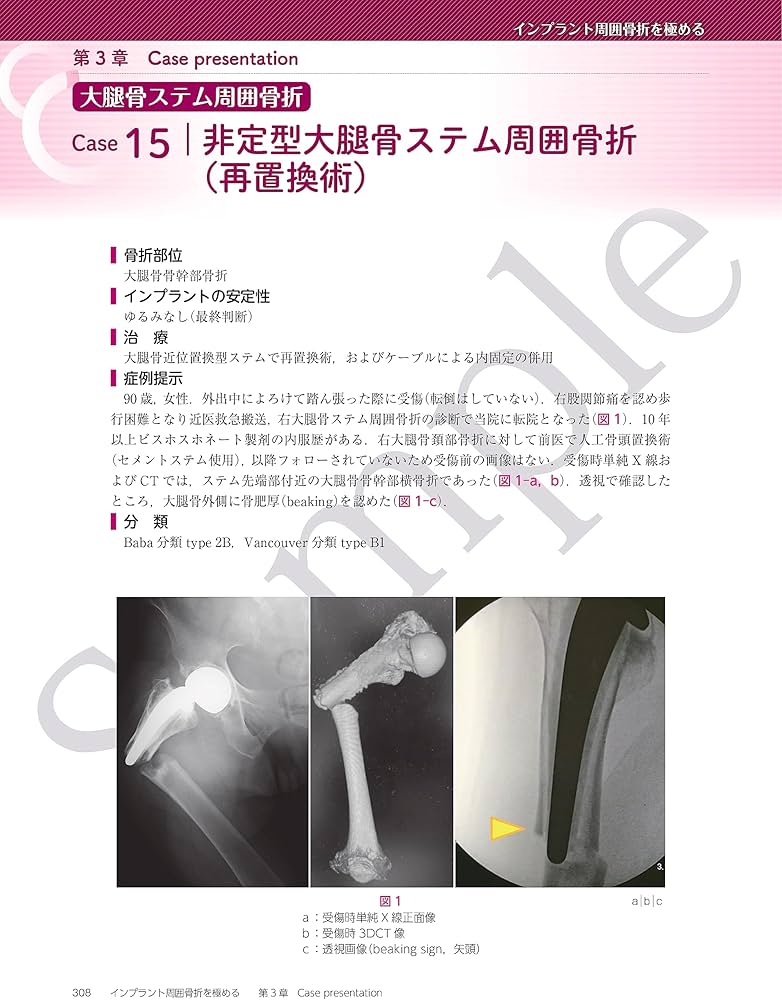 インプラント周囲骨折を極める | 馬場智規 |本 | 通販 | Amazon