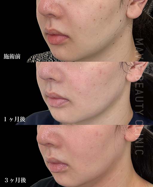 ほくろ・いぼ・シミ取り放題 | マヴィービューティークリニック