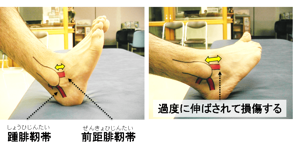 足関節捻挫（そくかんせつねんざ）｜医療法人 名圭会｜白岡整形外科