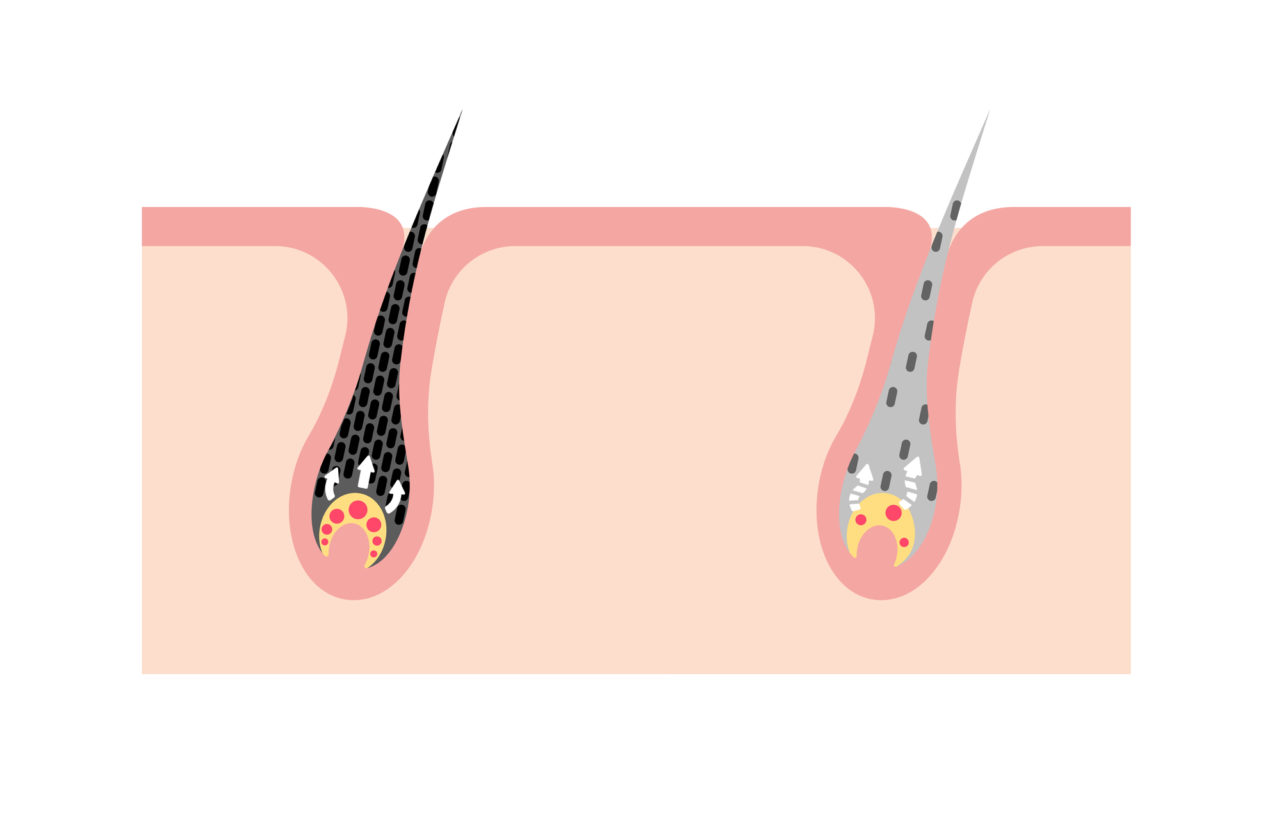 白髪があるとVIO脱毛はできない？！白髪の原因と永久脱毛する方法