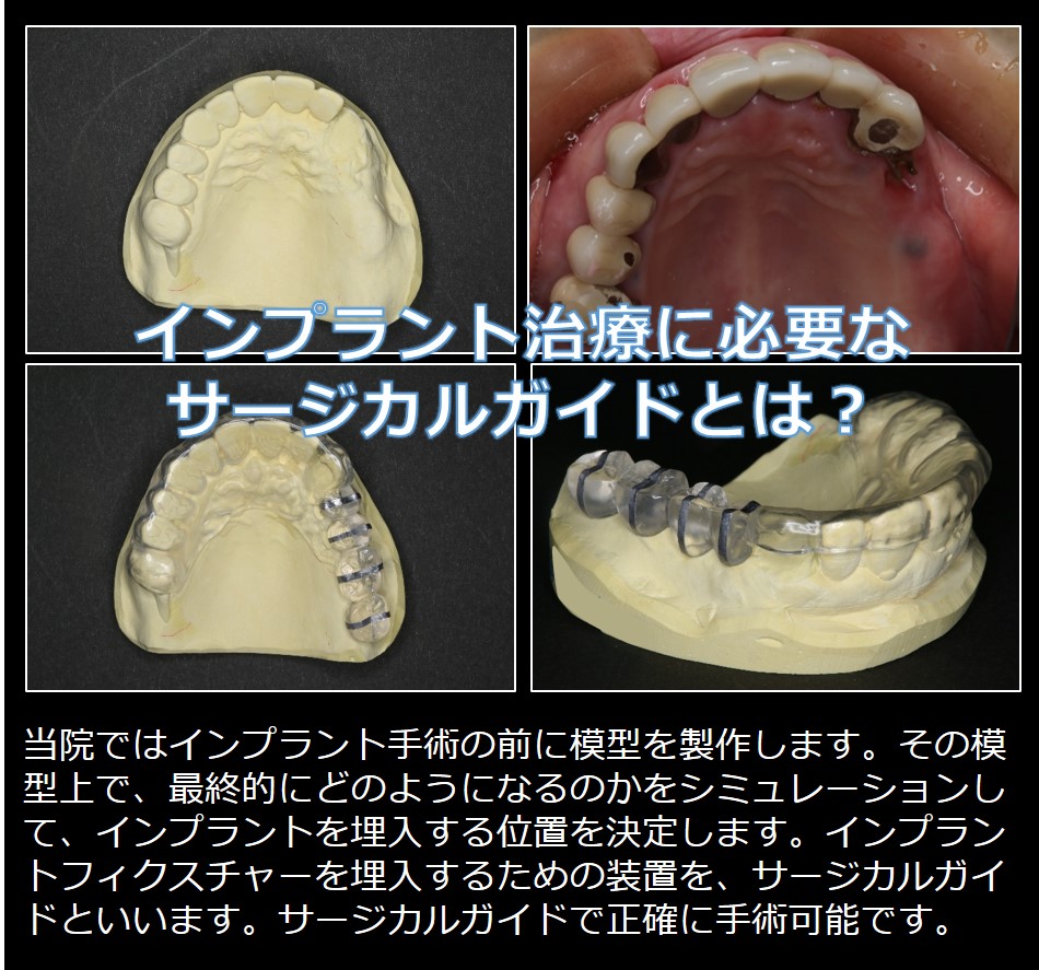 インプラントにはサージカルガイドとCT 虎ノ門ﾋﾙｽﾞ神谷町霞ヶ関の歯医者