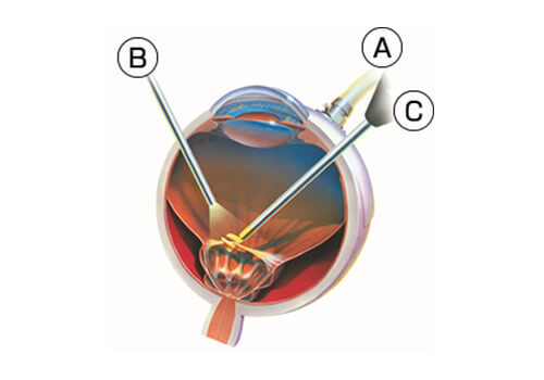 小切開硝子体手術｜望月眼科 老司本院 | 福岡市南区 | 多焦点レンズ