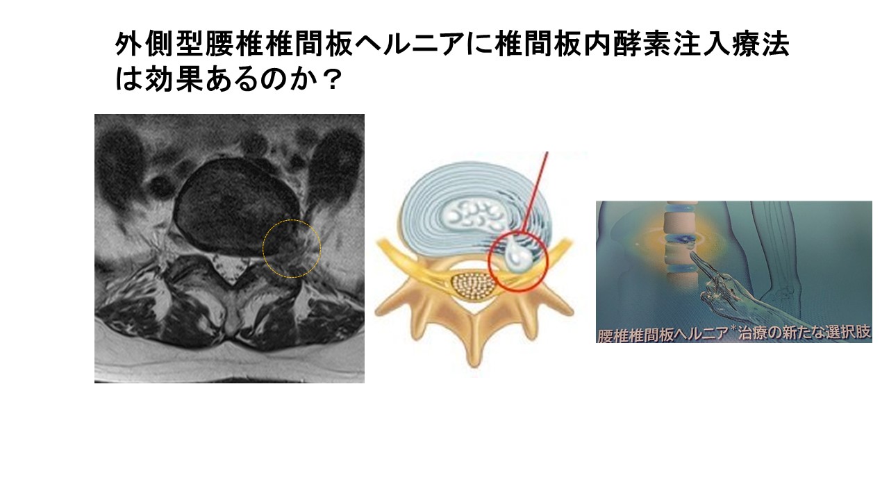 外側型腰椎椎間板ヘルニアに対する椎間板内酵素注入療法 ｜ 成尾整形
