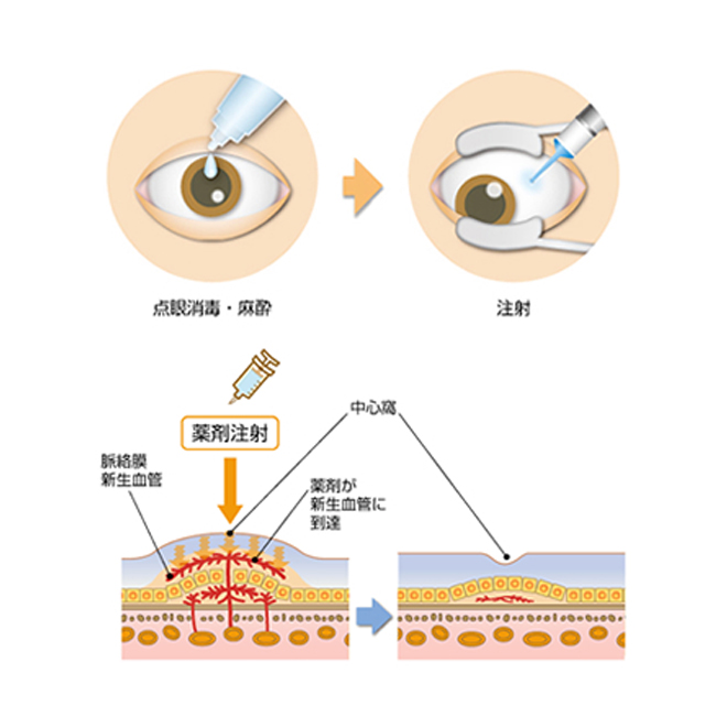 加齢黄斑変性症 | 野田眼科 大分市東春日町 選定療養実施施設