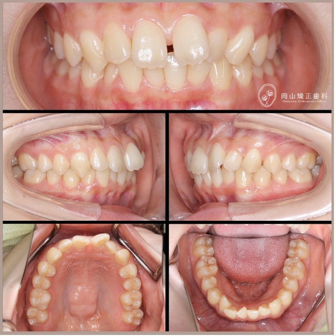 アライナー矯正（マウスピース型矯正装置） | 岡山矯正歯科