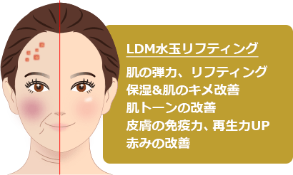LDM水玉リフティング | 新宿ラクル美容外科クリニック
