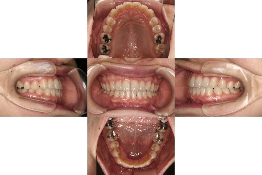 軽度の反対咬合を治したい | 札幌キュア矯正歯科
